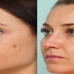 Age Spots, Can Be Eliminated