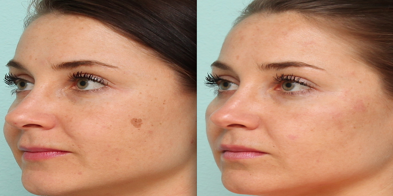 Age Spots, Can Be Eliminated?