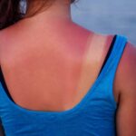 4 Home Remedies To Treat Sunburns