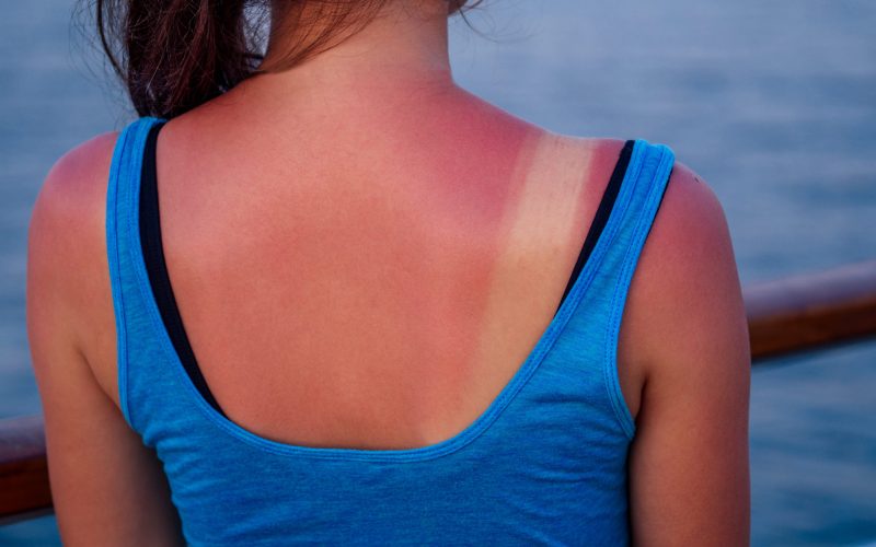4 Home Remedies To Treat Sunburns