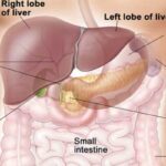 Transaminases, Liver Trouble